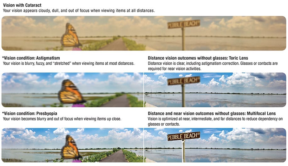 Cataract-Vision-Simulator Cataracts