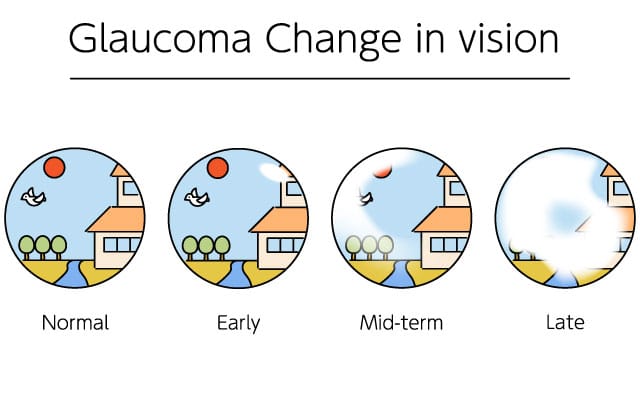 Glaucoma progression