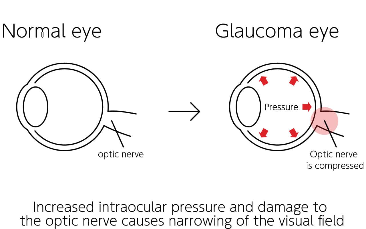 What is glaucoma?